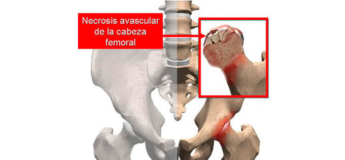 Necrosis de la cabeza femoral
