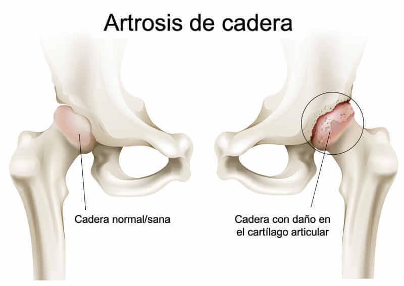 Artrosis de cadera