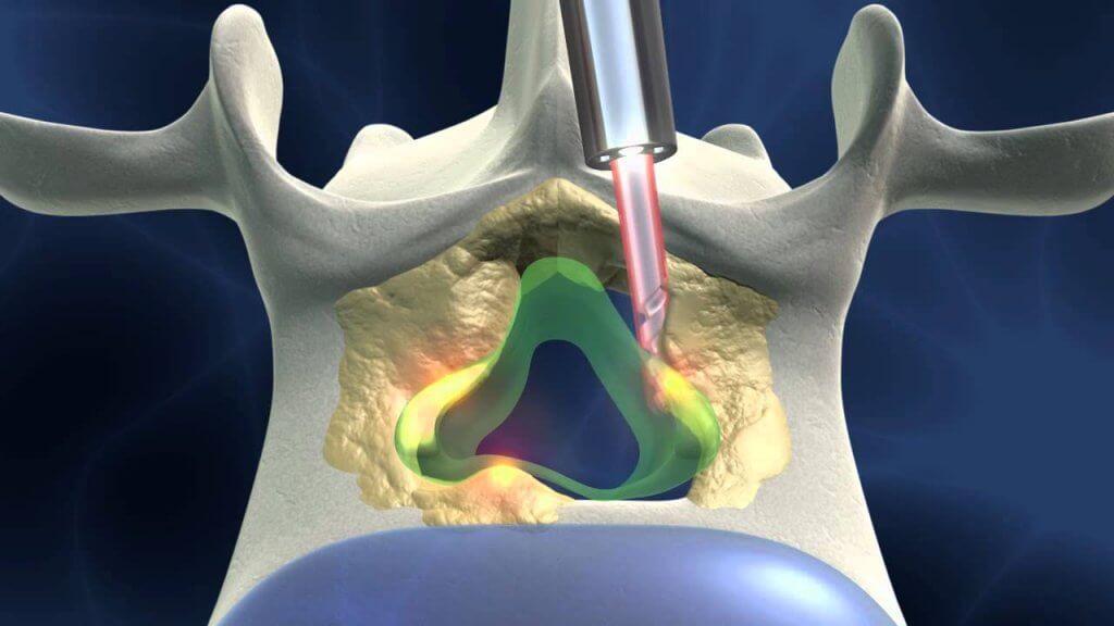 Cirugía lumbar percutánea. 