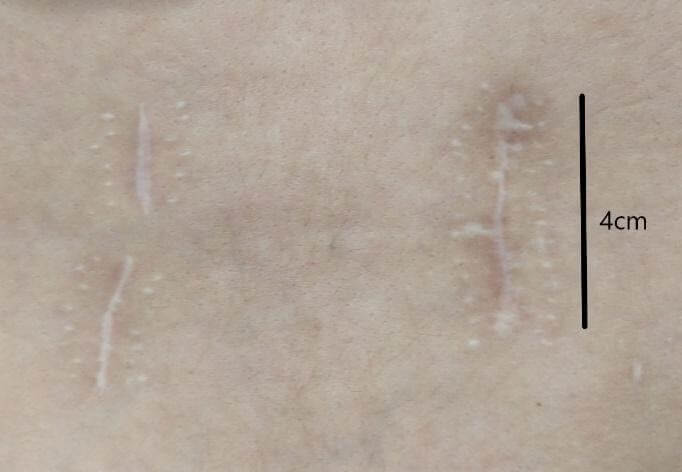 Cicatriz cirugía lumbar percutanea