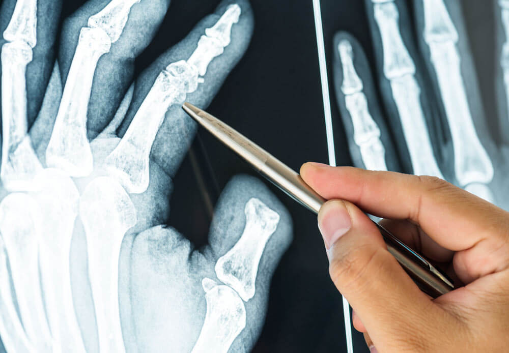 Infecciones óseas postraumáticas